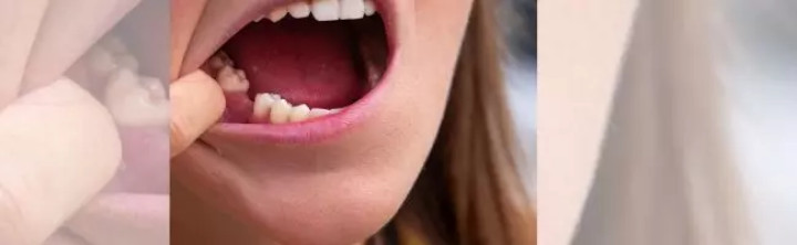 Önerő nélkül is igényelhető a fogászati célú személyi kölcsön