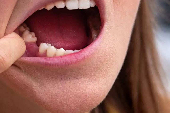 Önerő nélkül is igényelhető a fogászati célú személyi kölcsön