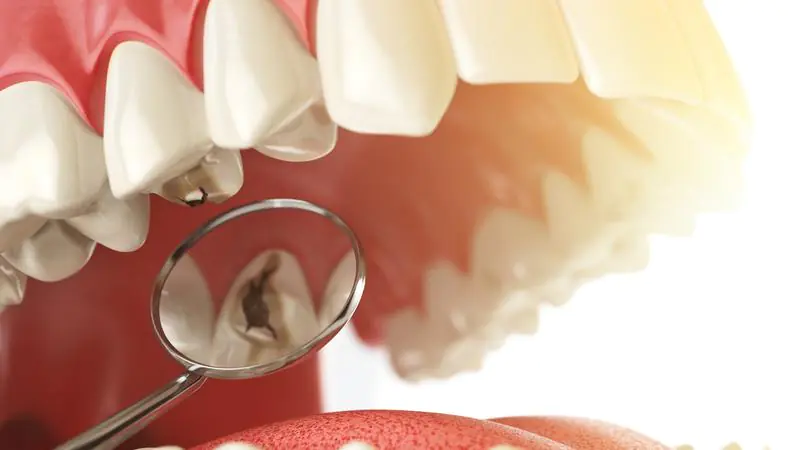 Mi is t&ouml;rt&eacute;nik pontosan a fogszuvasod&aacute;s sor&aacute;n, ami az egyik leggyakoribb sz&aacute;jbetegs&eacute;g, &eacute;s amitől annyian retteg&uuml;nk?