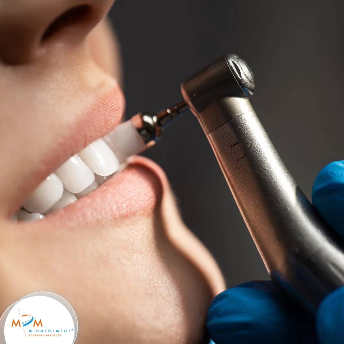 S&oacute;pol&iacute;roz&aacute;s - k&iacute;m&eacute;letes tiszt&iacute;t&aacute;s &eacute;s friss mosoly egy l&eacute;p&eacute;sben