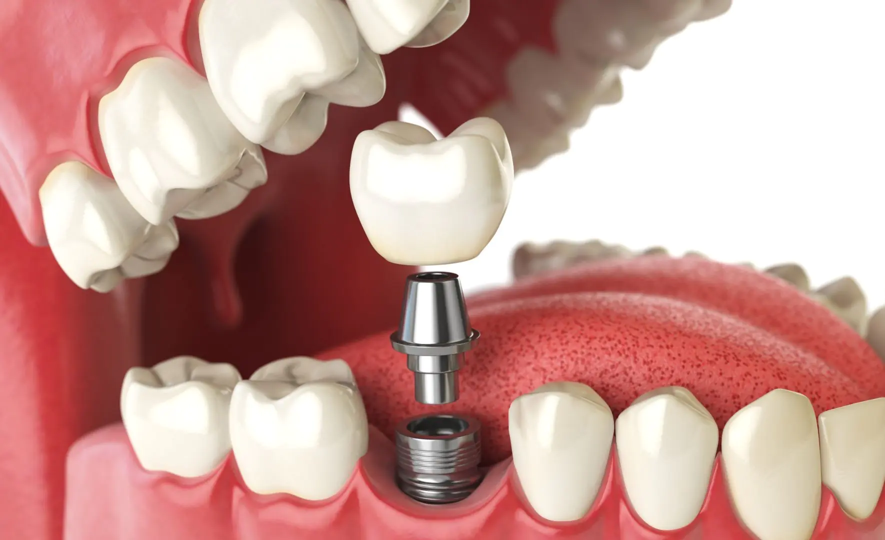 Az 5 leggyakoribb kérdés a fog implantátumokkal kapcsolatban