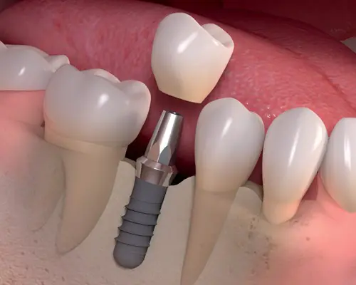 Esztétikus fogpótlás fix fogimplantátummal – mi ez pontosan, és mire való?