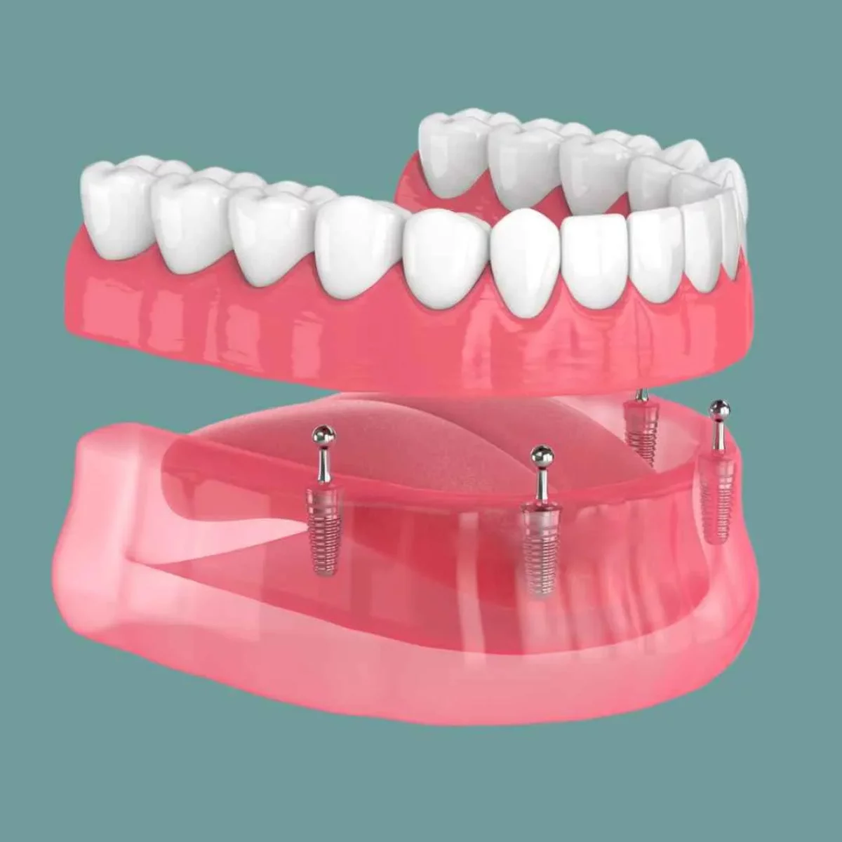 Mini implant&aacute;tum: stabilabb megold&aacute;s lehet a mozg&oacute; kivehető fogsorra?