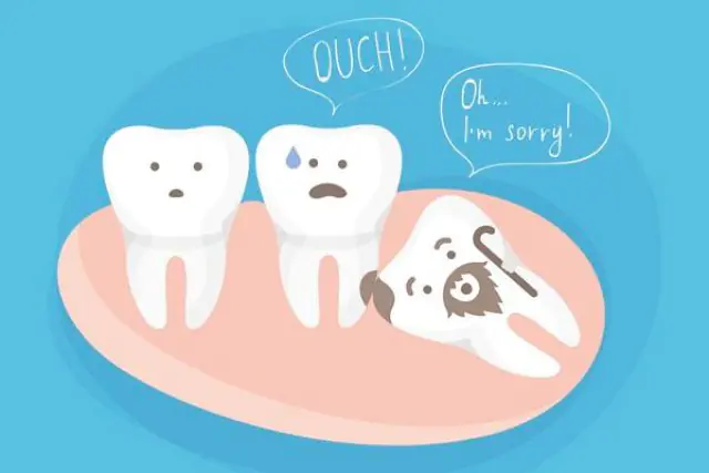 Bölcsességfog: mikor indokolt a kivétel, és mikor felesleges?