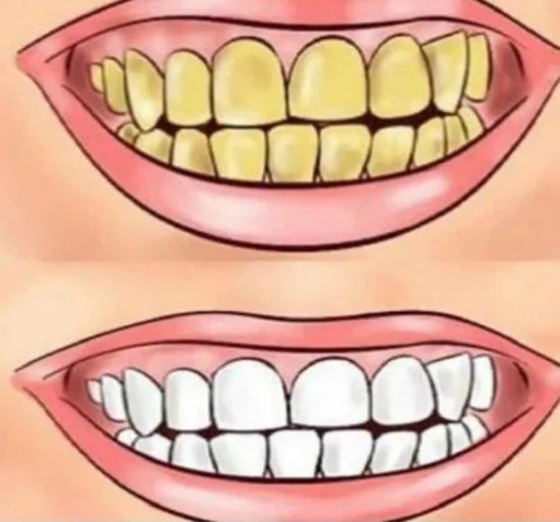 Sokféle ok vezethet elszíneződött, sárga fogakhoz.