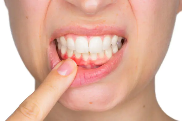 Mi okozza a fogíny visszahúzódását, és mi rá a legjobb megoldás?