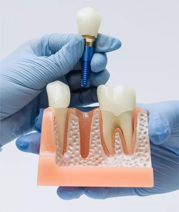 fog implant&aacute;tum