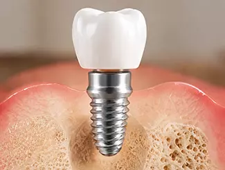 implant