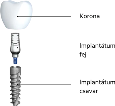 fog-implant&aacute;tum metszet