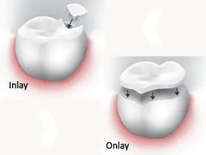 inlay, onlay kép