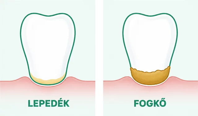 fogkő