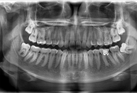 Panoráma röntgen felvétel, fogászati röntgen, fogröntgen
