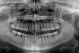 Panoráma röntgen felvétel, fogászati röntgen, fogröntgen